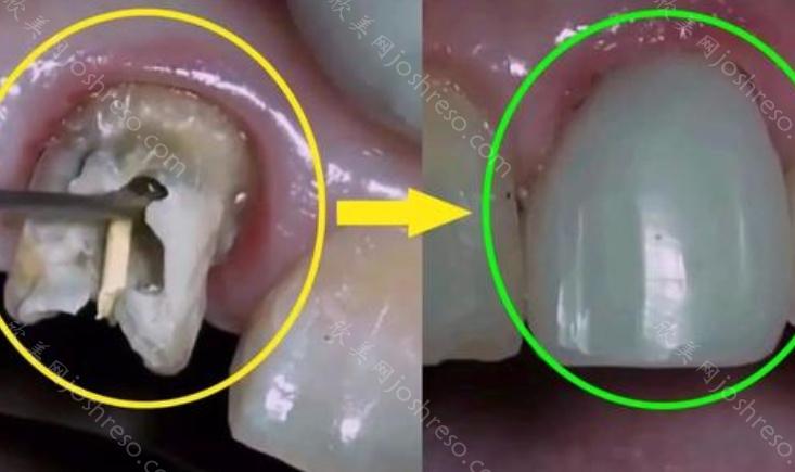 如何做口腔修复牙齿缺失