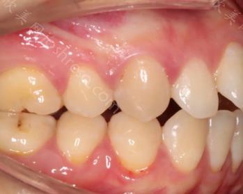 微龅牙矫正前后图片，微龅牙矫正需要多久？真人案例分享！