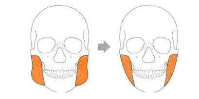 滕利八大处案例：下颌角颧骨，八大处滕利医生做下颌角颧骨整形好吗？