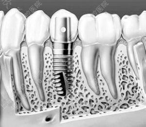 种植牙的寿命有多长 影响因素有很多