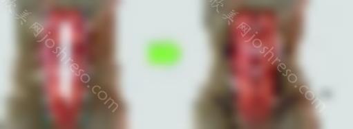 抽脂减肥多少钱?抽脂收费多少?手术前必备！