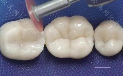 补牙3m树脂z350与z250哪个好？做补牙选材质你会选吗？