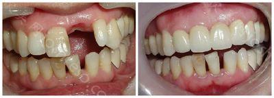 牙齿缺失后什么情况下适合做种植牙修复