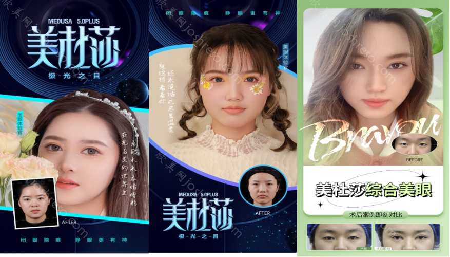 西安米兰柏羽哪位医生做双眼皮好?实力专家张筠莉医生介绍-附案例+价格