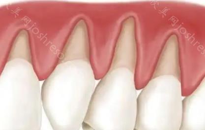 牙龈萎缩和正常牙龈图片对比，牙龈萎缩是什么原因导致的？