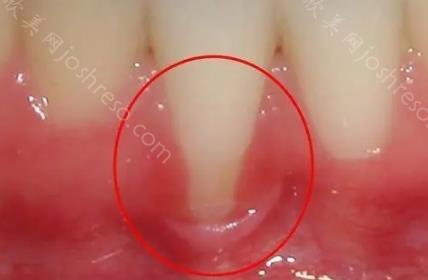 牙龈萎缩和正常牙龈图片对比，牙龈萎缩是什么原因导致的？