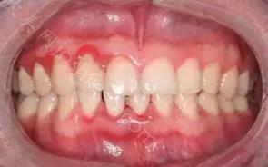 牙周袋长什么样子图片？牙周袋有哪些症状？