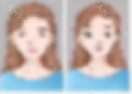 温良情境的假体隆鼻修复术后照