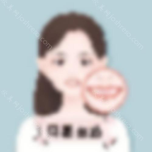 绍兴维美美容医院岳辉鼻修复成功案例-术后150天效果图