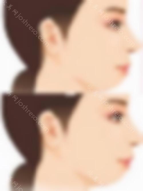 萧璇的假体隆鼻修复术后照
