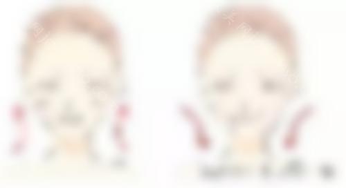 的自体软骨隆鼻术后照