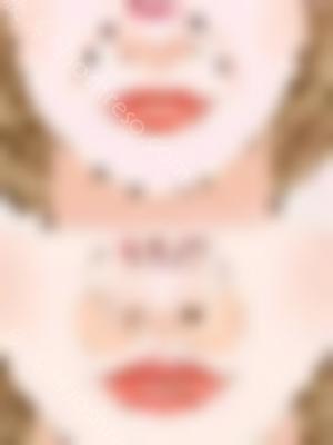 小小小阿的鼻综合整形术后照