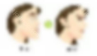 像向日葵一样的轮廓三件套术前照
