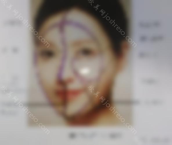 蒋欣凌下颌角整形案例_术后114天效果图