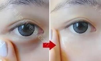 外切祛眼袋手术1至10天照片，外切去眼袋需要多久恢复好？