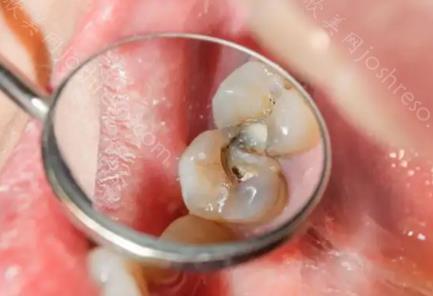 宁愿虫牙继续蛀也不愿意补牙对吗？补牙对口腔健康有危害吗？