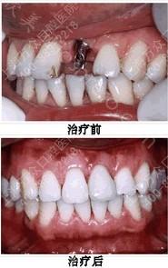 拔牙后多久可以安装种植牙 3个月左右