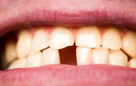 少一颗牙少活10年真的吗？缺少牙齿会对身体造成哪些危害？