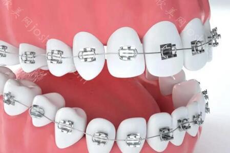 戴牙套1-12个月变化图，牙齿矫治一年变化真人案例分享！