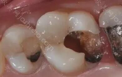 大牙烂到什么程度必须拔牙图片？拔牙后应该如何保护口腔健康？