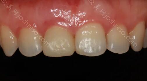 临时牙安装效果图，临时牙可以永久使用吗？