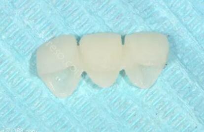 临时牙安装效果图，临时牙可以永久使用吗？