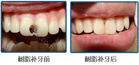多颗牙齿缺失会有哪些危害影响呢