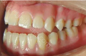 标准的牙齿咬合图，判断自己牙齿排列是否正常