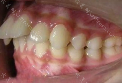 标准的牙齿咬合图，判断自己牙齿排列是否正常