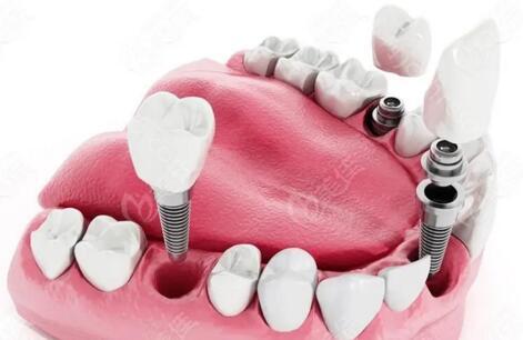 大牙坏了种植一颗多少钱？大牙种植费用受哪些因素影响？