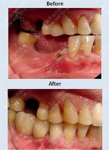 种植牙修复后寿命可以维持多久呢