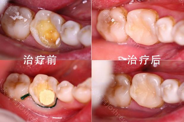上海治疗牙齿缺失的方法有哪些