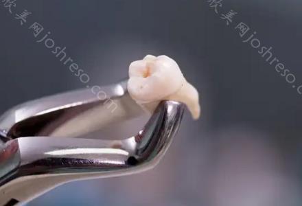 拔智齿医院贵还是牙科诊所贵？深度解析拔智齿费用形成因素！