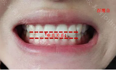 上下牙龈正常是什么样的图片?用一张标准的咬合图告诉你
