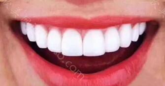 牙齿贴面害了多少人？牙齿贴面对牙齿健康有害吗？