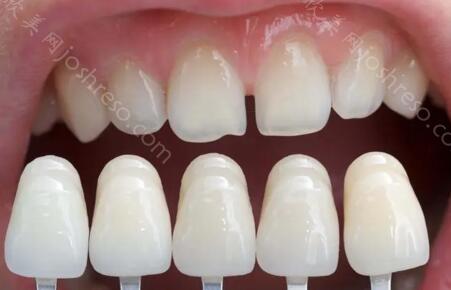 牙齿贴面害了多少人？牙齿贴面对牙齿健康有害吗？