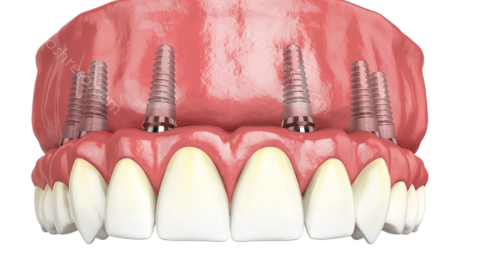 假牙/种植牙会影响我们做核磁共振及CT检查吗?