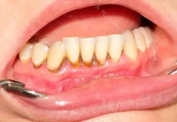 牙龈炎症状图片并附带牙龈炎治疗方法