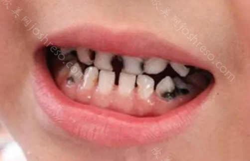 乳牙成为龋齿不治疗对孩子的影响有哪些?孩子补牙全麻花了2万