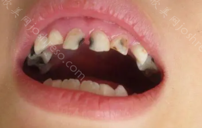 乳牙成为龋齿不治疗对孩子的影响有哪些?孩子补牙全麻花了2万