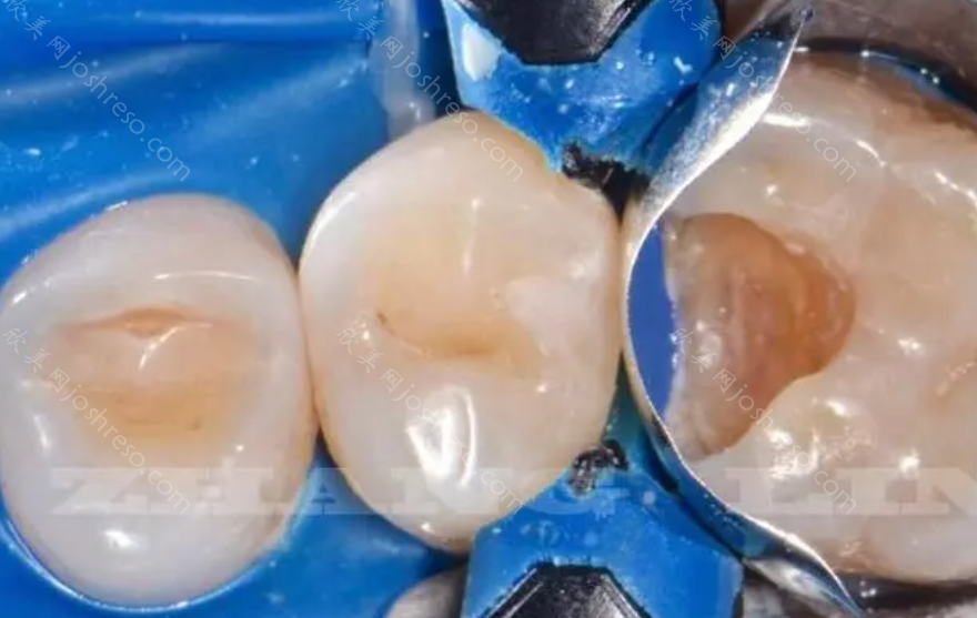 磨小了牙做全瓷牙真牙会烂吗?自身的牙齿会受到伤害吗?