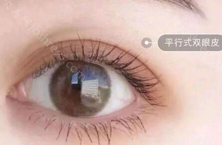 北京双眼皮修复填脂专家谭章梅医生技术好吗？谭章梅医生修复双眼皮费用？