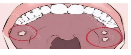 牙龈瘤、牙龈癌、牙龈增生怎么区分?具体看这