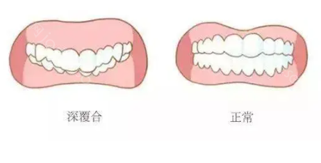 嘴巴闭上的时候上牙包住下牙正常吗?典型的天包地畸形牙齿