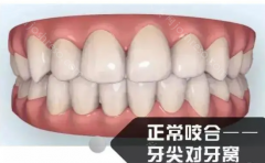 嘴巴闭上的时候上牙包住下牙正常吗?典型的天包地畸形牙齿