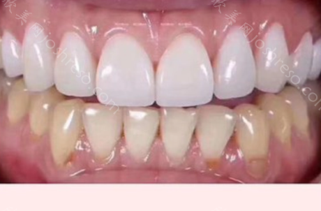 树脂贴面牙卸掉后和原来还一样吗?牙贴面怎么拆除?