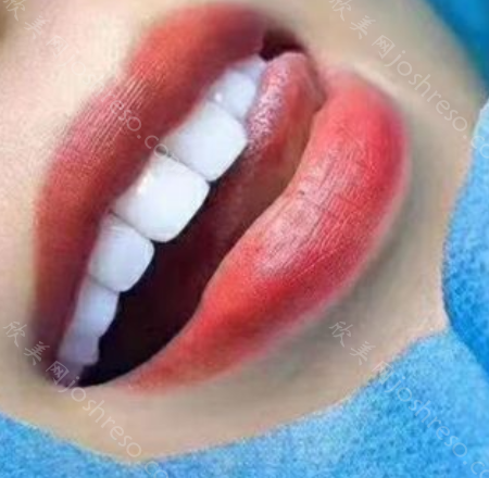 树脂贴面牙卸掉后和原来还一样吗?牙贴面怎么拆除?