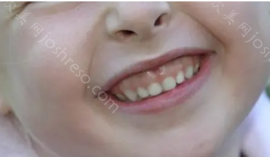 儿童露牙龈笑能矫正吗?分享露龈笑手术费用