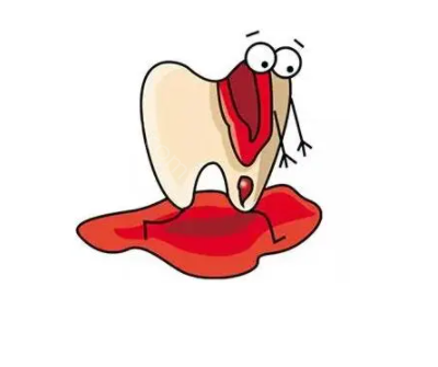牙龈脓肿切开引流术图片步骤：具体操作图片来告诉你