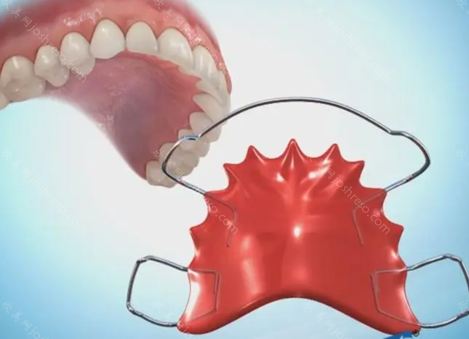 牙齿保持器的种类和价格图，几天不戴保持器会造成什么后果?